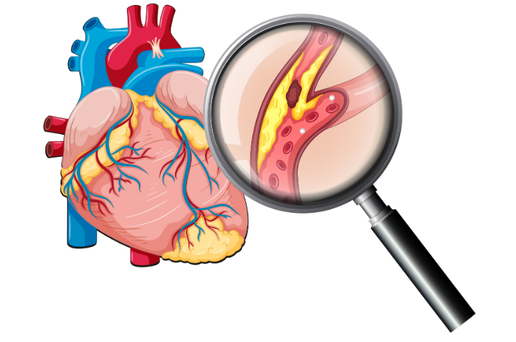 Coronary